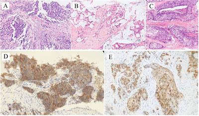 Case Report: 18F-PSMA PET/CT May Improve the Clinical Management of Penile Metastases From Prostate Cancer